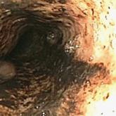 Black Esophagus: A Rare Cause of Gastrointestinal Hemorrhage in the Emergency Department