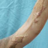 Laser Scar Management: Focused and High-Intensity Medical Exchange in Vietnam