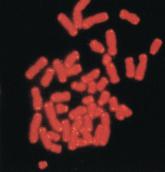 Telomere length linked to COPD exacerbations, mortality