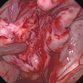 Morcellation at the time of vaginal hysterectomy