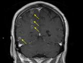 Brain abscesses in a 60-year-old man