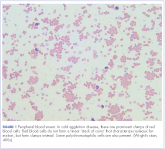 Cold hemolytic anemia: a rare complication of influenza A