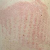 Over-the-counter Topical Musculoskeletal Pain Relievers Used With a Heat Source: A Dangerous Combination