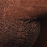 An Atypical Syphilis Presentation