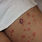 Lichen Planus Pemphigoides Treated With Ustekinumab