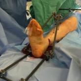 Intraoperative Use of External Fixator Attachments for Reduction of Lower Extremity Fractures and Dislocations