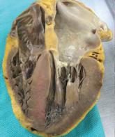 Cardiac amyloidosis: An update on diagnosis and treatment