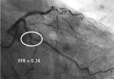 Management of coronary chronic total occlusion