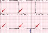 Hypothermia and severe first-degree heart block