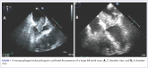 Cardiac pleomorphic sarcoma after placement of Dacron graft