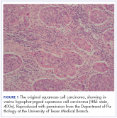 Recurrent head and neck cancer presenting as a large retroperitoneal mass