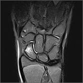 Bilateral wrist pain • limited range of motion • tenderness to palpation • Dx?