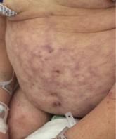 Primary livedo reticularis of the abdomen