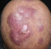 Hypopigmented Discoloration on the Thigh