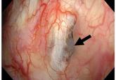 Ascites from intraperitoneal urine leakage after pelvic radiation