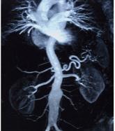 Hemodynamically, the kidney is at the heart of cardiorenal syndrome