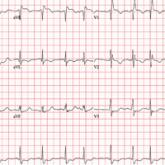 Breaking More Than the Fall