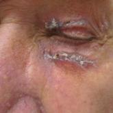 Periorbital Lupuslike Presentation of Graft-versus-host Disease