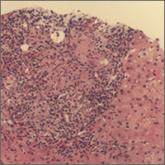 Elevated serum alkaline phosphatase • generalized pruritus • Dx?