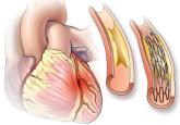 PCI for stable angina: A missed opportunity for shared decision-making