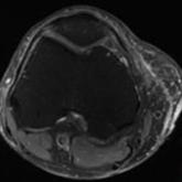 Lower Limb Morel-Lavallée Lesion Treated With Short-Stretch Compression Bandaging