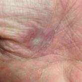 eruptive vellus hair cysts face