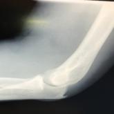 Vascular Injury Following a Fall Onto an Outstretched Hand