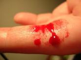 finger bleeding 