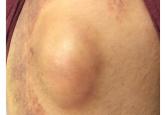 A lump on the hip