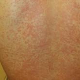 Man, 25, With Sinus Pain, Sore Throat, and Rash