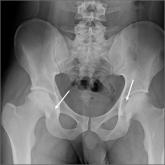 Anterolateral hip pain • no specific injury • Dx?