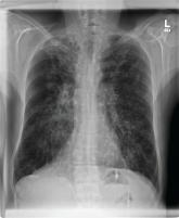 Later diagnosis predicts poorer outcomes in adult-diagnosed cystic fibrosis