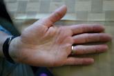 Female predisposition to anxiety disorders may have prenatal origin