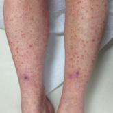 Leukocytoclastic Vasculitis Resolution With Topical Dapsone