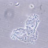 Effective treatment of recurrent bacterial vaginosis