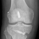 Applying Military Strategy to Complex Knee Reconstruction: Tips for Planning and Executing Advanced Surgery