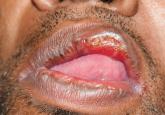 Secondary syphilis