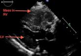 A large mass in the right ventricle: Tumor or thrombus?