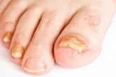 Limitations with molecular techniques in detecting onychomycosis