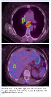 Striking rash in a patient with lung cancer on a checkpoint inhibitor