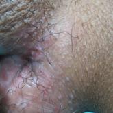 Painless Ulcer on the Areola