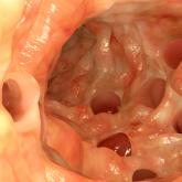 First-time, mild diverticulitis: Antibiotics or watchful waiting?