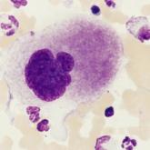 Thrombocytopenia and neutropenia: A structured approach to evaluation Thrombocytopenia and neutropenia: A structured approach to evaluation