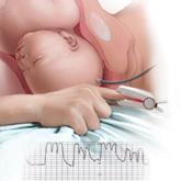 How to differentiate maternal from fetal heart rate patterns on electronic fetal monitoring