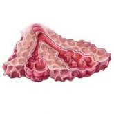 Pharmacologic Treatments for Idiopathic Pulmonary Fibrosis