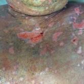 A Recalcitrant Case of Toxic Epidermal Necrolysis