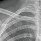 Severe right upper chest pain • tender right sternoclavicular joint • Dx?