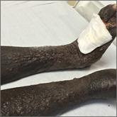 Bilateral nonpitting edema and xerotic skin