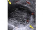 Musculoskeletal ultrasonography basics