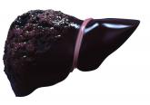 Survival worse with alcohol-related HCC, compared with other types